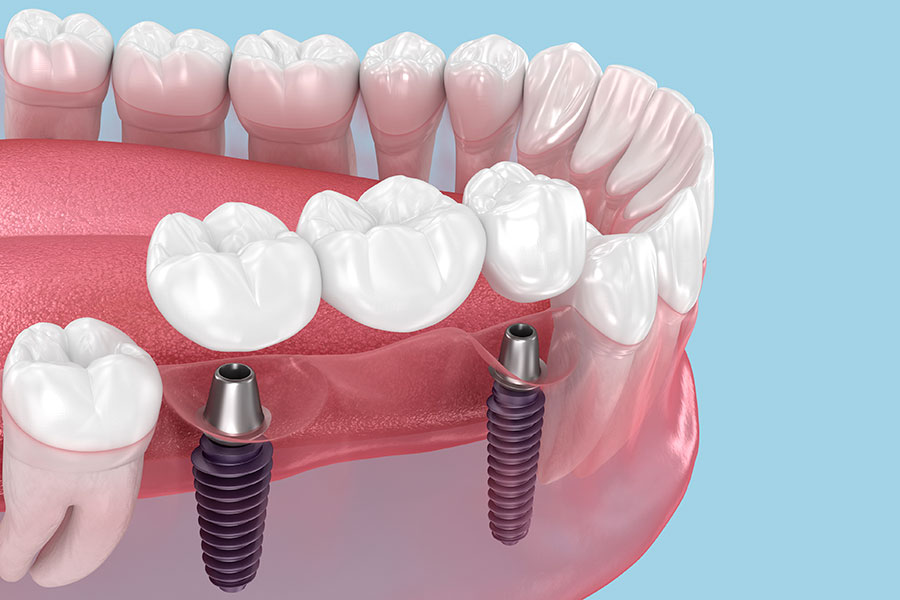 Bridge-Dentiste-Dunkerque