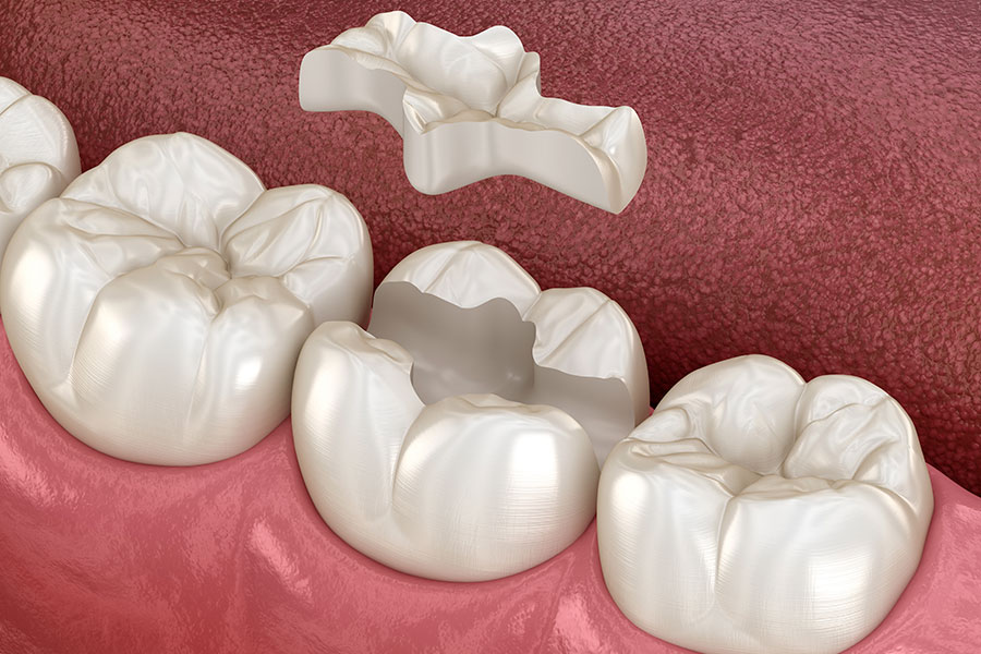 Inlay-Onlay-Dentiste-Dunkerque