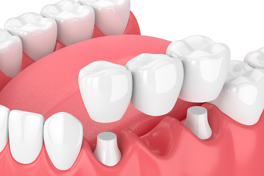 Prothese-fixe-Dentiste-Dunkerque