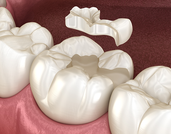 inlays-onlays-Dentiste-Dunkerque